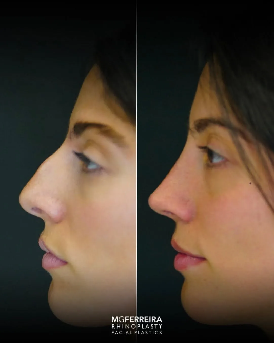 Rinoplastia pós-traumática: desvio nasal complexo, vista oblíqua