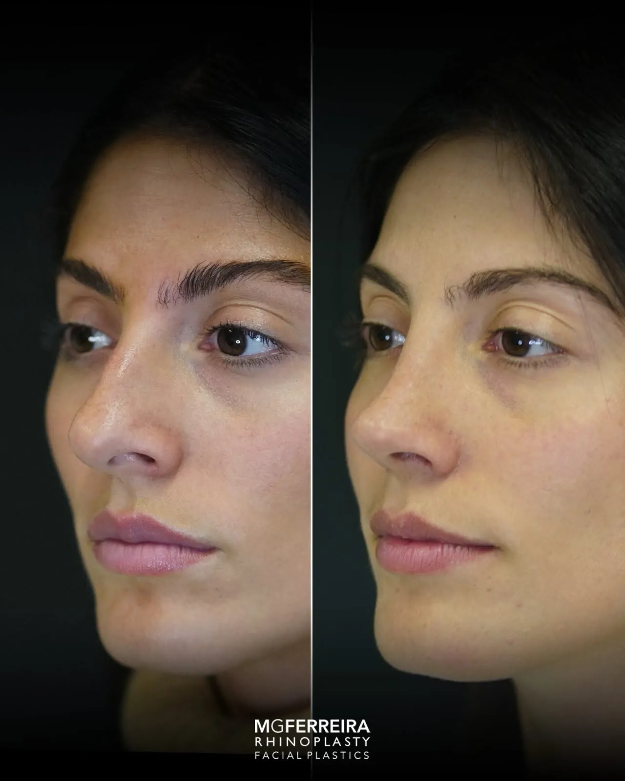 Rinoplastia pós-traumática: desvio nasal complexo, vista oblíqua