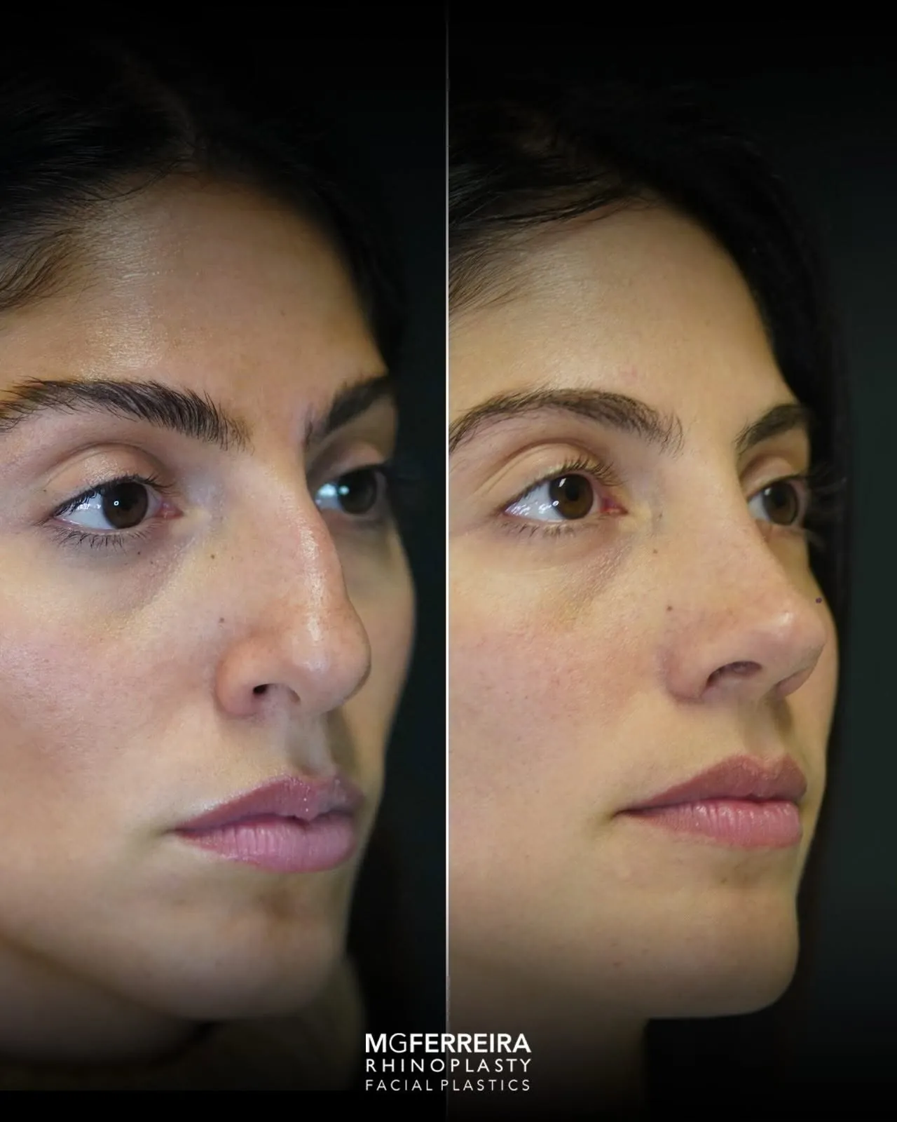 Rinoplastia pós-traumática: desvio nasal complexo, vista oblíqua oposta