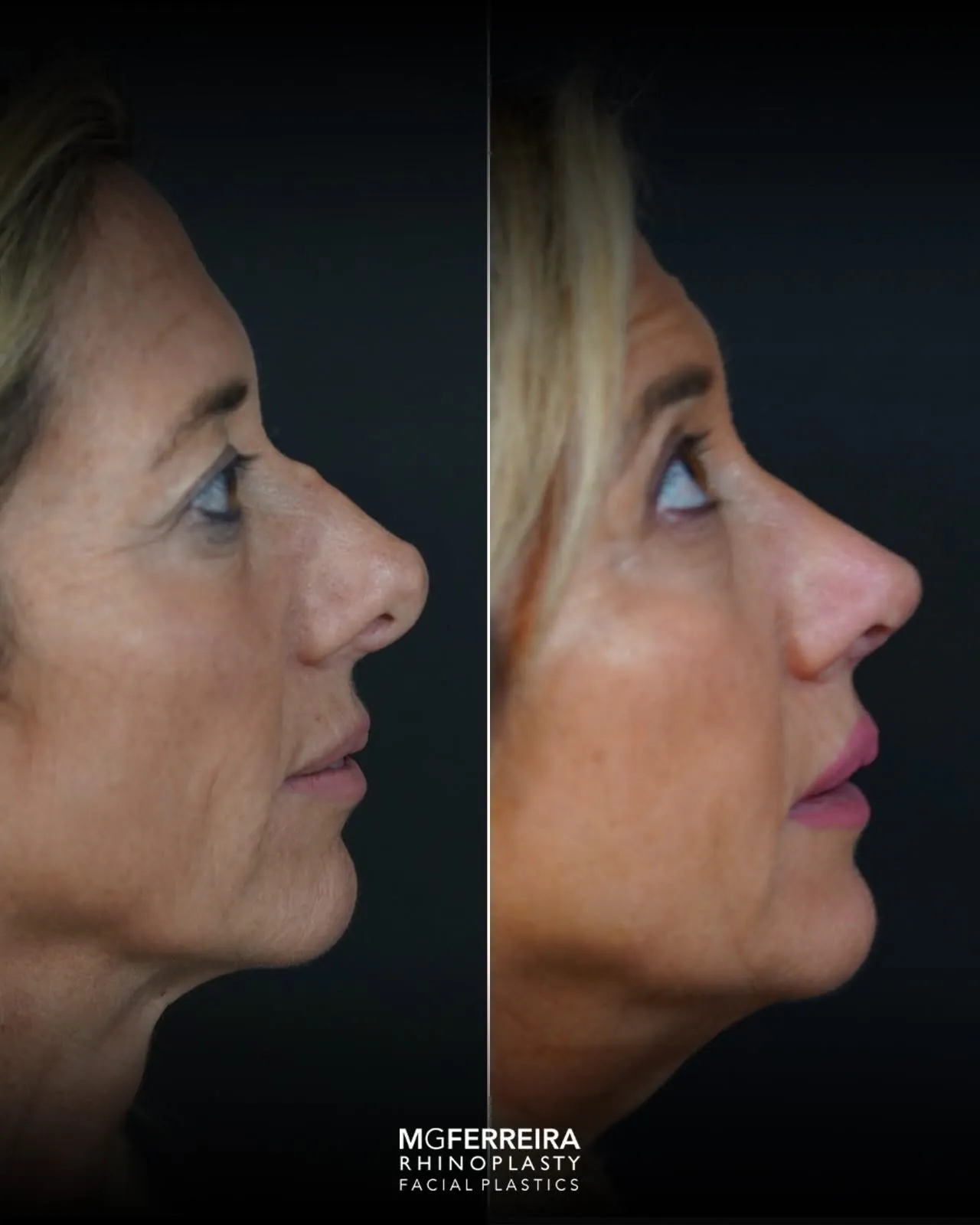 Rinoplastia revisional: correção de nariz desviado, perfil