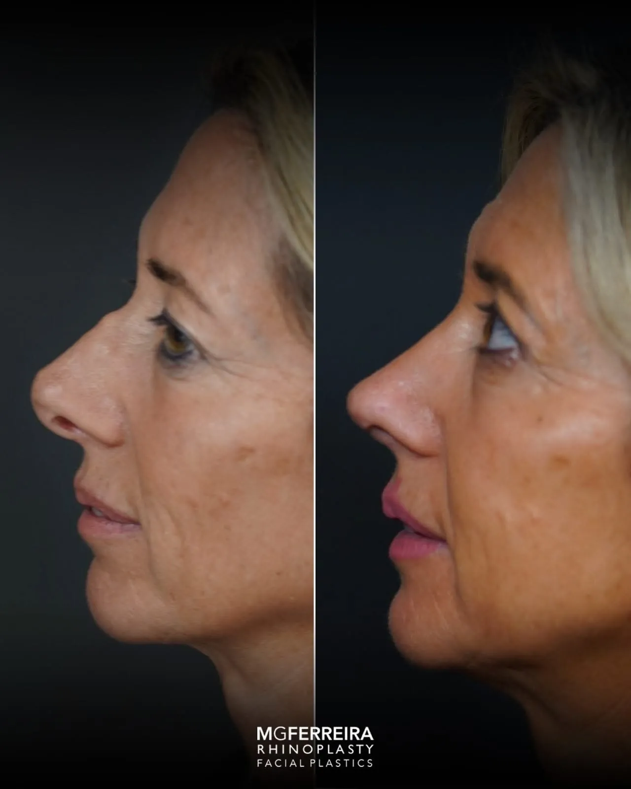 Rinoplastia revisional: correção de nariz desviado, perfil oposto