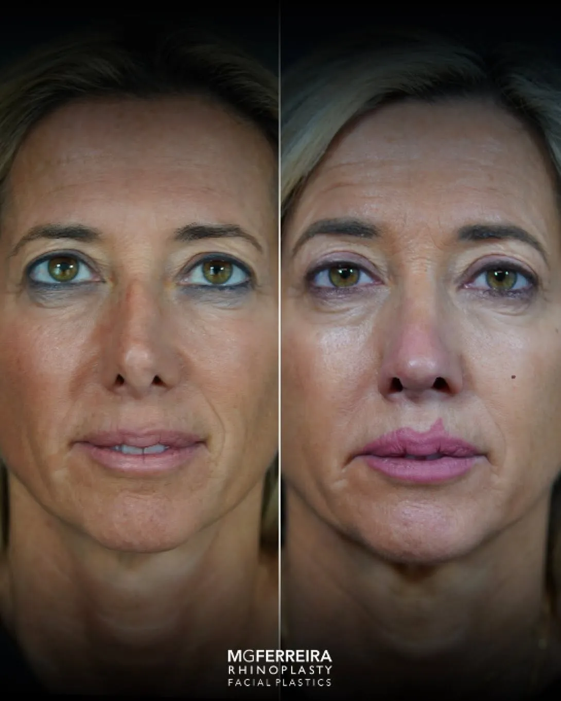 Rinoplastia revisional: correção de nariz desviado, vista frontal