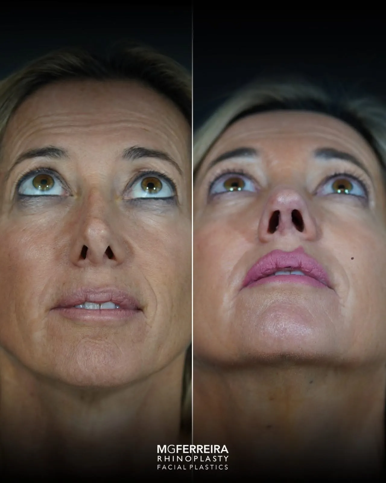 Rinoplastia revisional: correção de nariz desviado, vista inferior