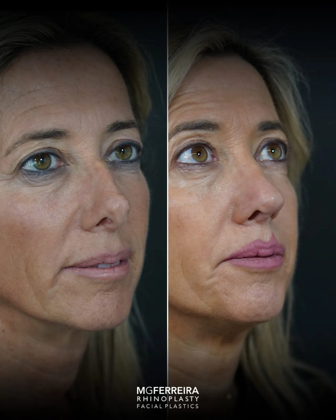 Rinoplastia revisional: correção de nariz desviado, vista oblíqua