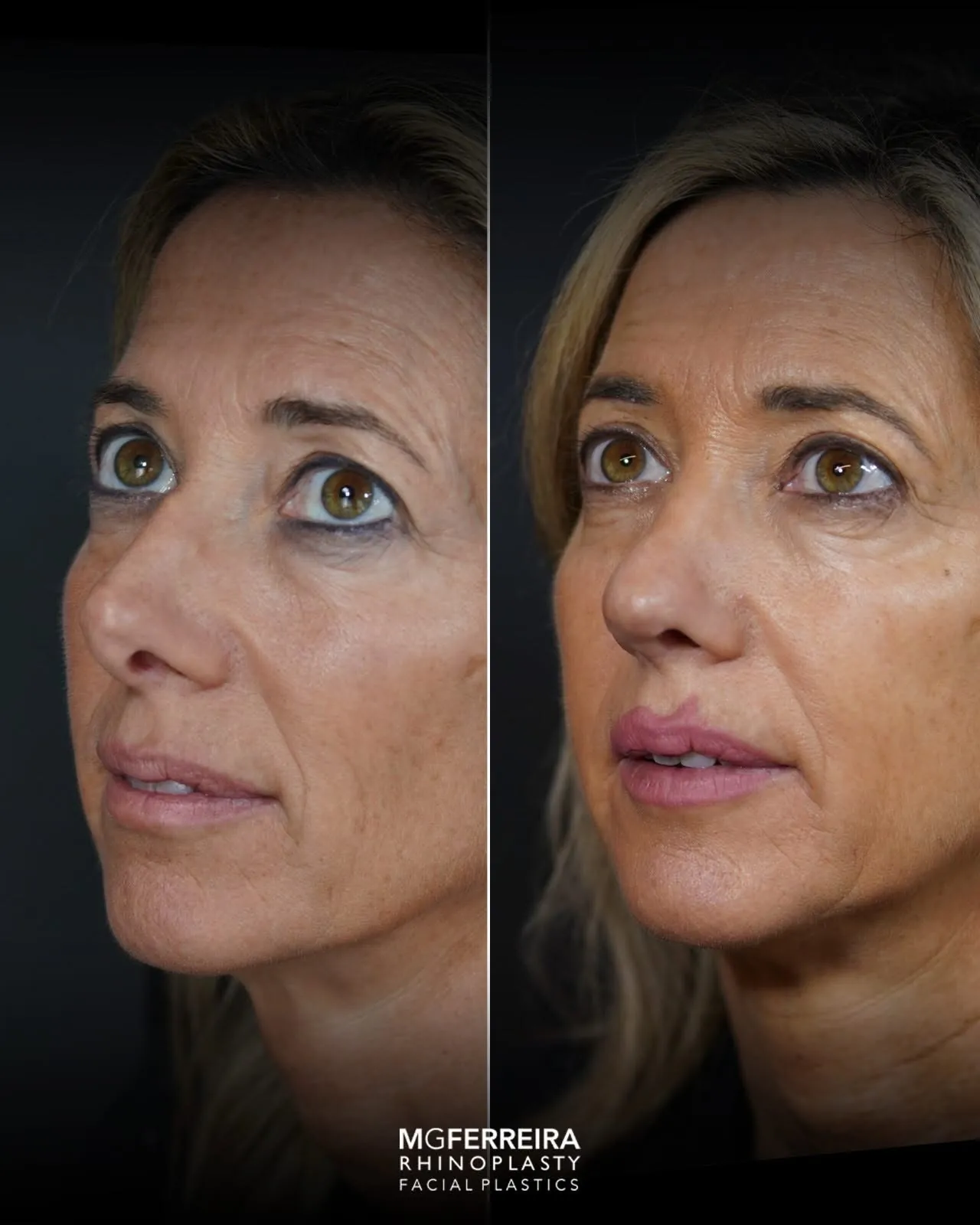 Rinoplastia revisional: correção de nariz desviado, vista oblíqua oposta