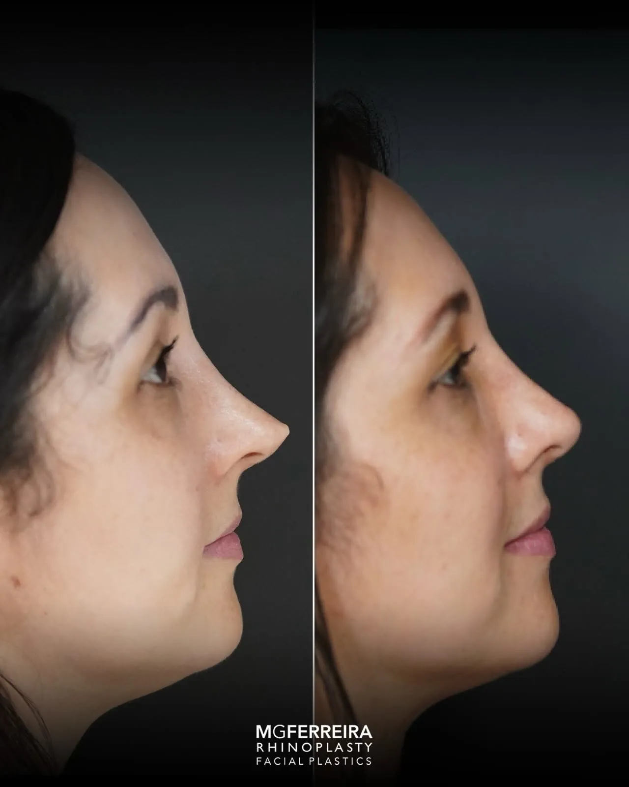 Antes e depois de rinoplastia revisional, comparação de perfil