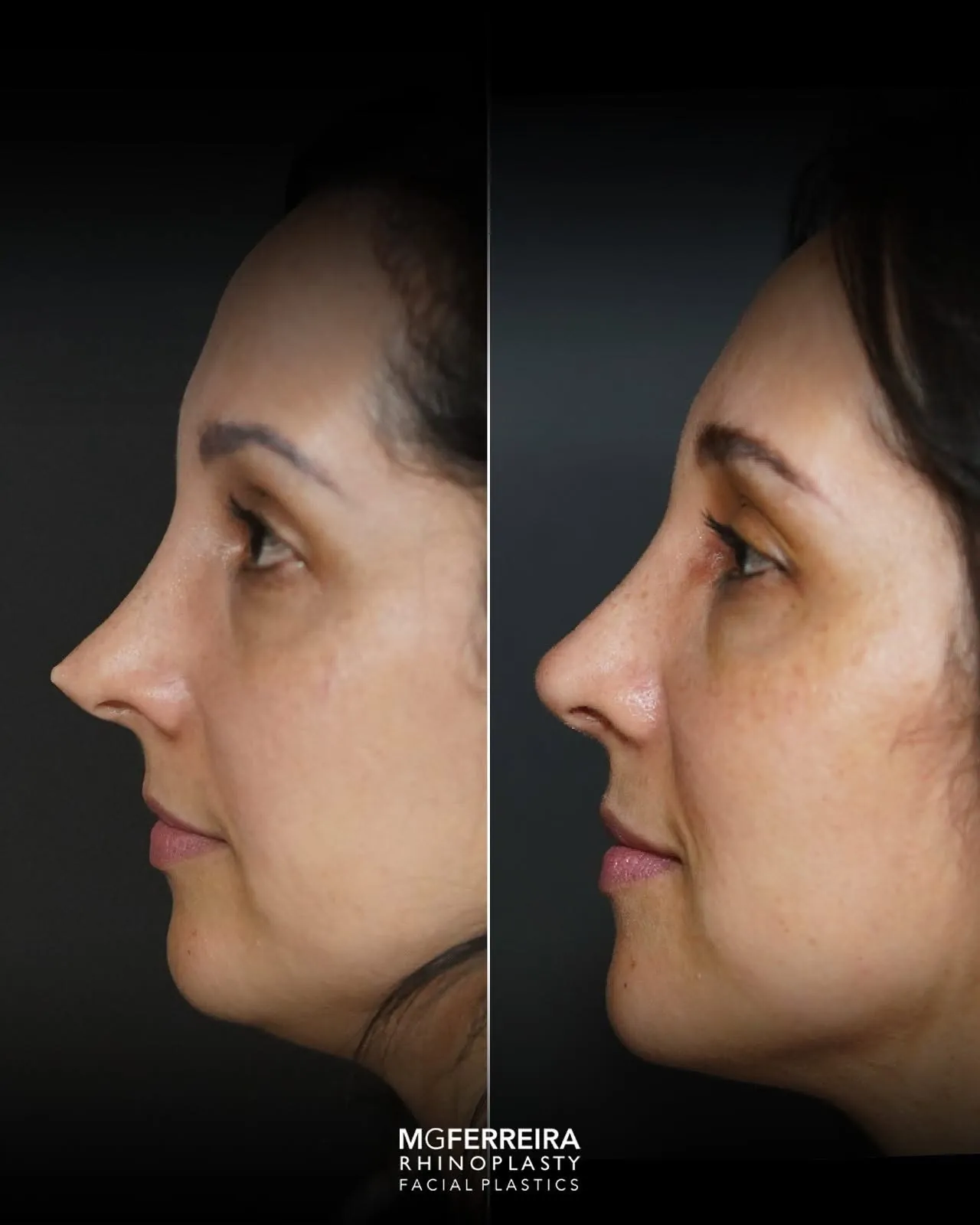 Antes e depois de rinoplastia revisional, comparação do perfil oposto