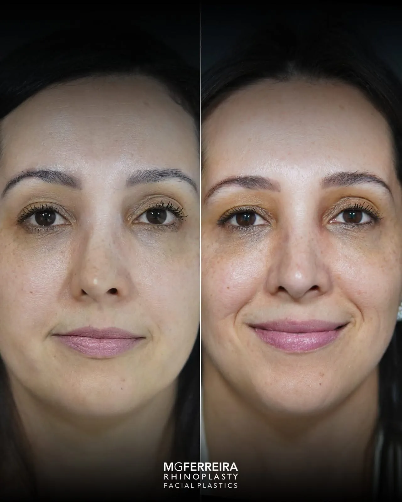 Antes e depois de rinoplastia revisional em nariz complexo, vista frontal
