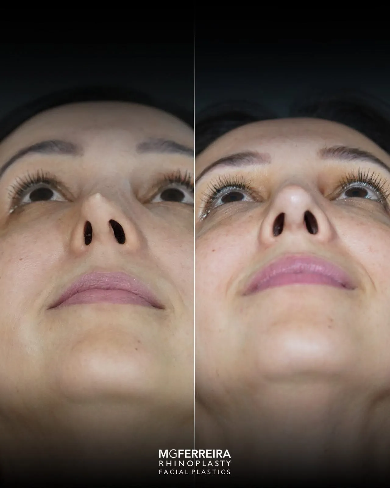 Antes e depois de rinoplastia revisional, vista inferior do nariz
