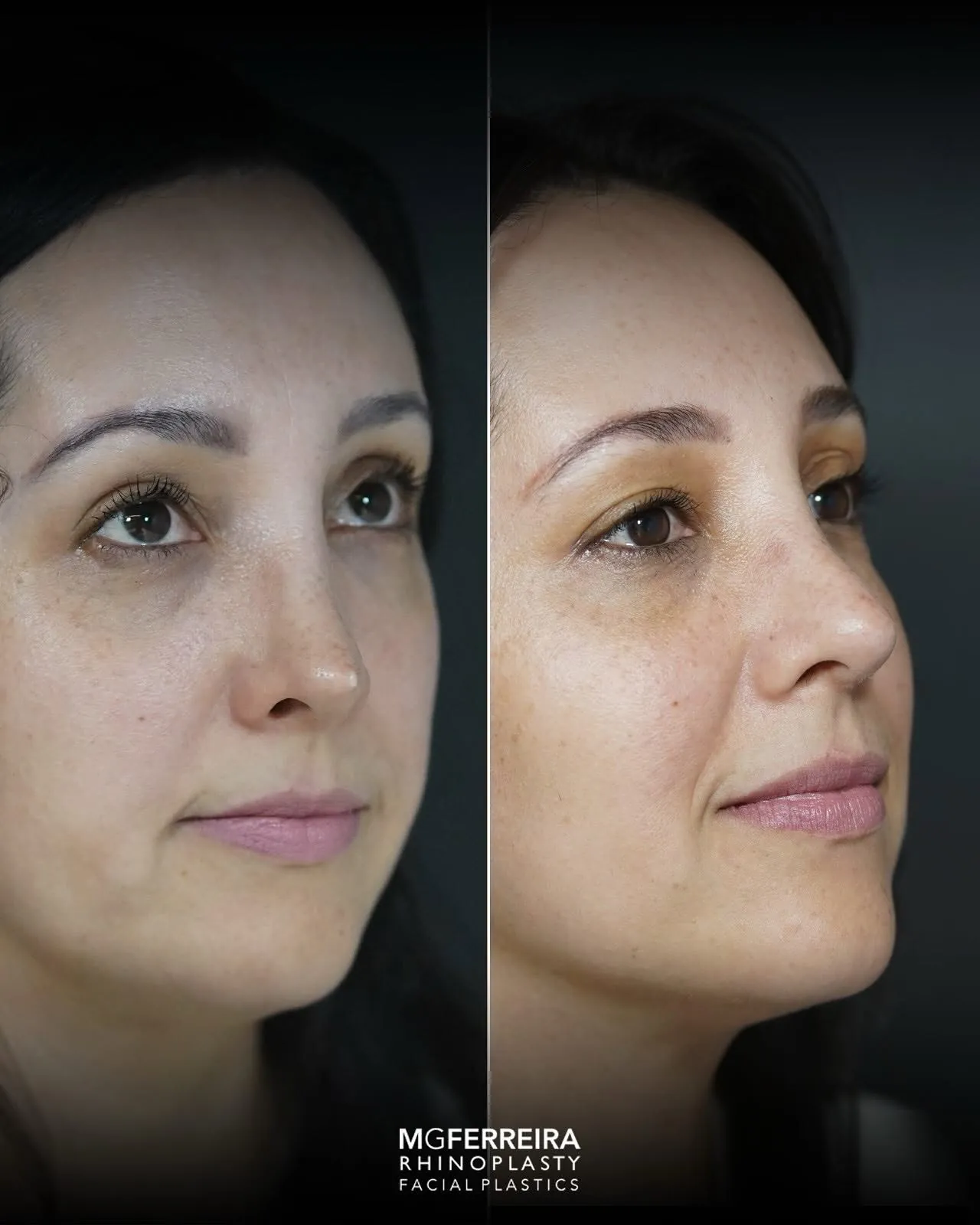 Antes e depois de rinoplastia revisional, vista oblíqua