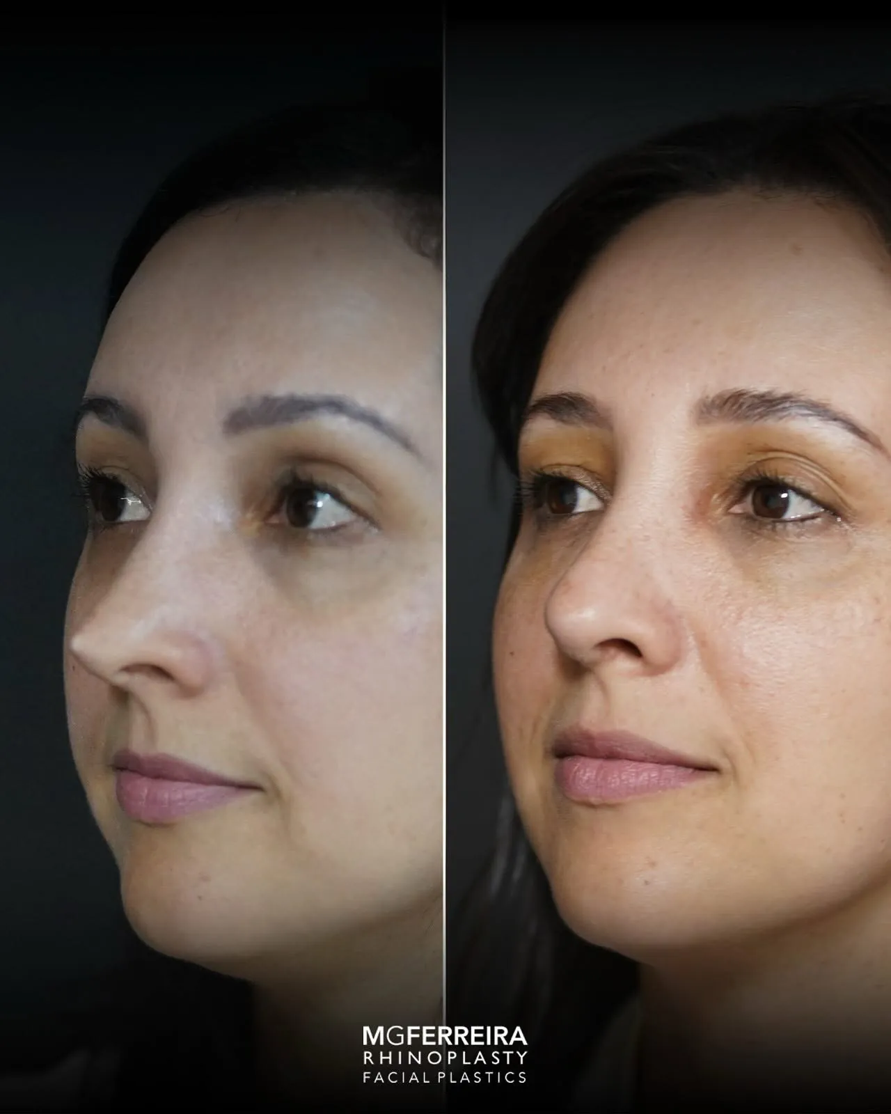 Antes e depois de rinoplastia revisional, vista oblíqua oposta