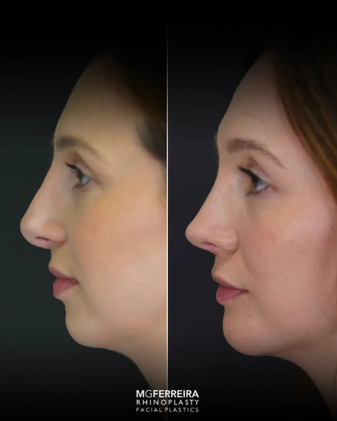 Rinoplastia terciária: acompanhamento de uma revisão complexa, perfil