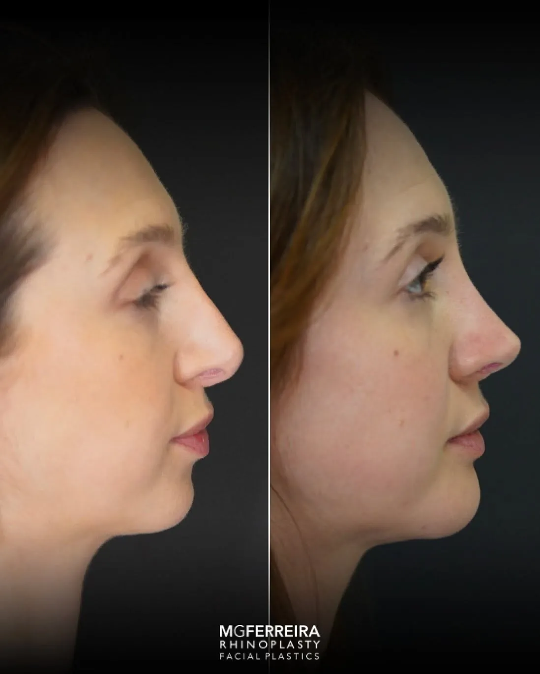 Rinoplastia terciária: acompanhamento de uma revisão complexa, perfil oposto