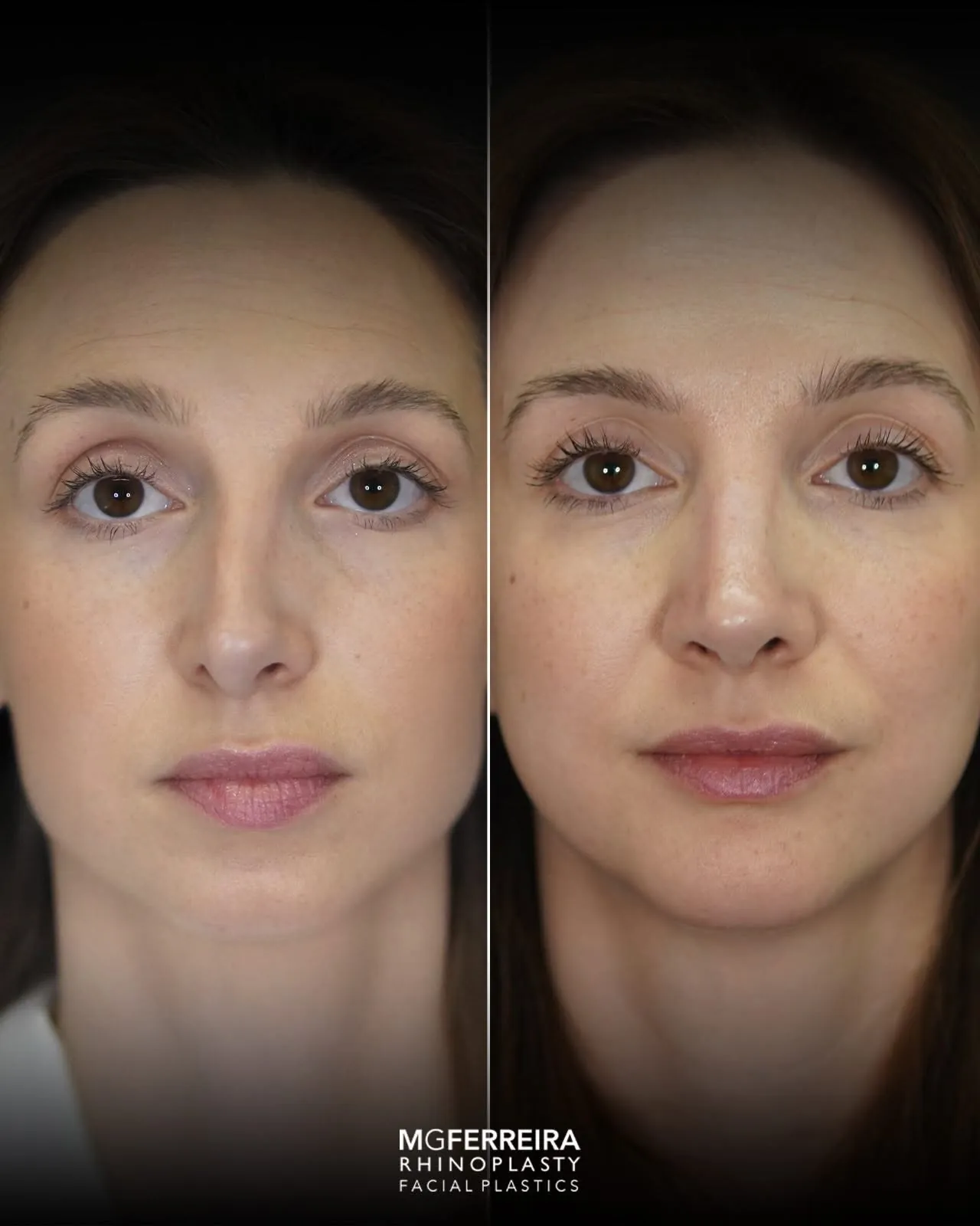 Rinoplastia terciária: acompanhamento de uma revisão complexa, vista frontal