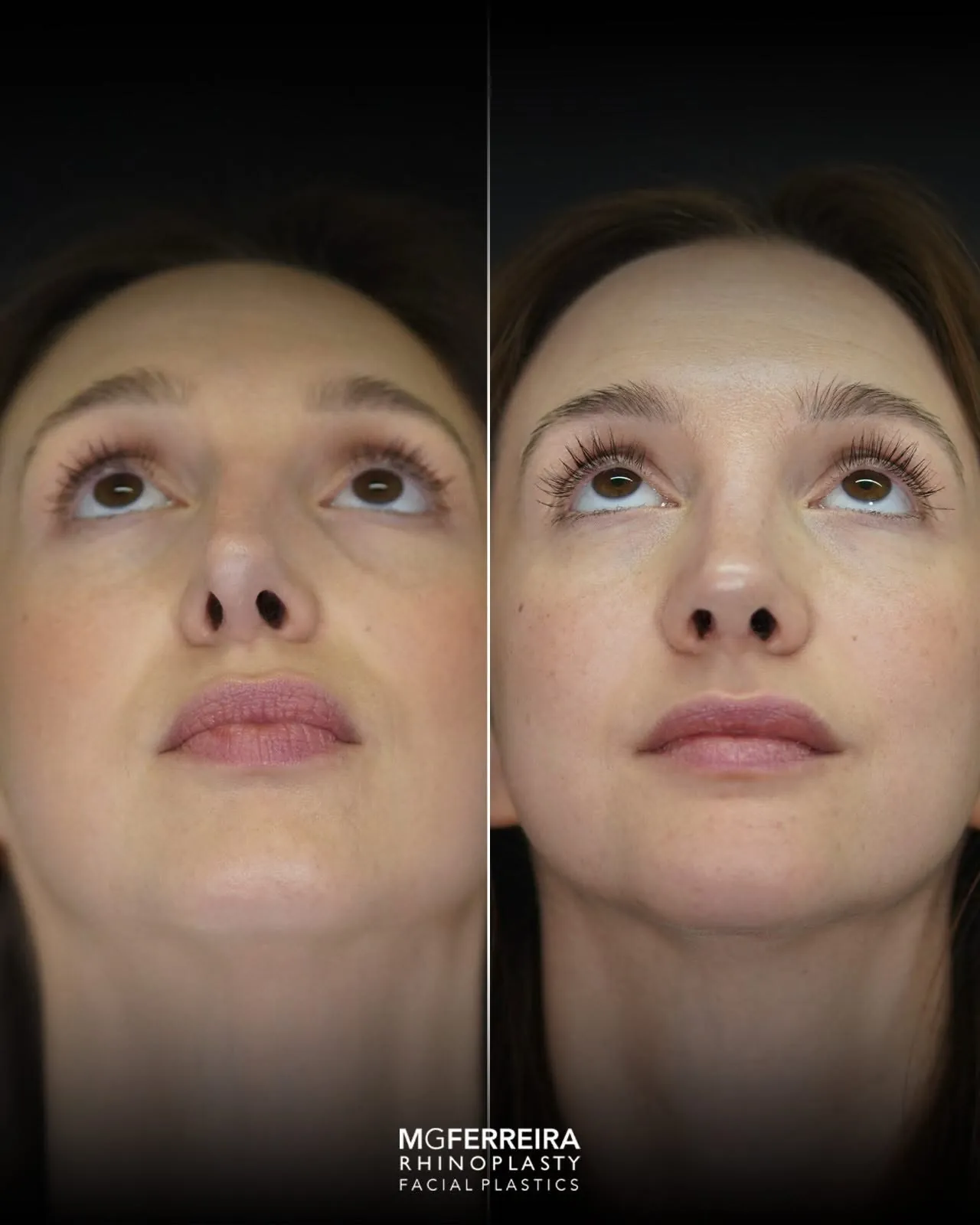 Rinoplastia terciária: acompanhamento de uma revisão complexa, vista inferior