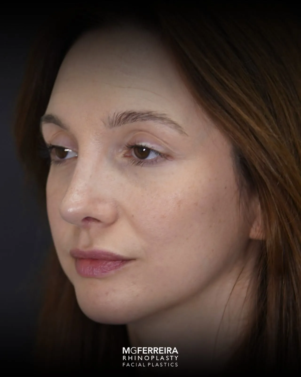 Rinoplastia terciária: acompanhamento de uma revisão complexa, vista oblíqua